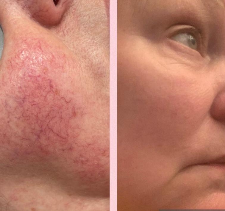 thread-vein-removal