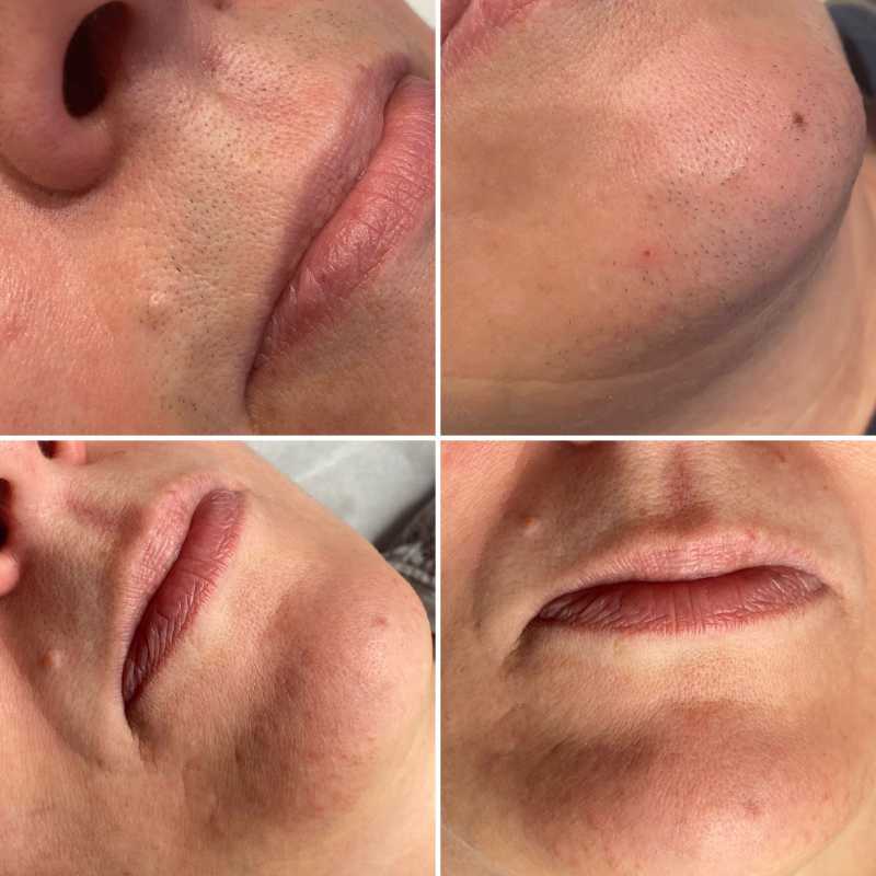 ipl-hair-removal-halesowen