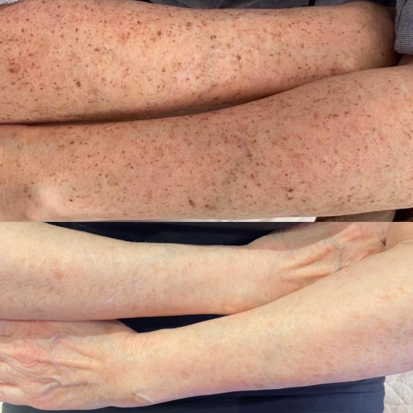 ipl-for-pigmentation-halesowen