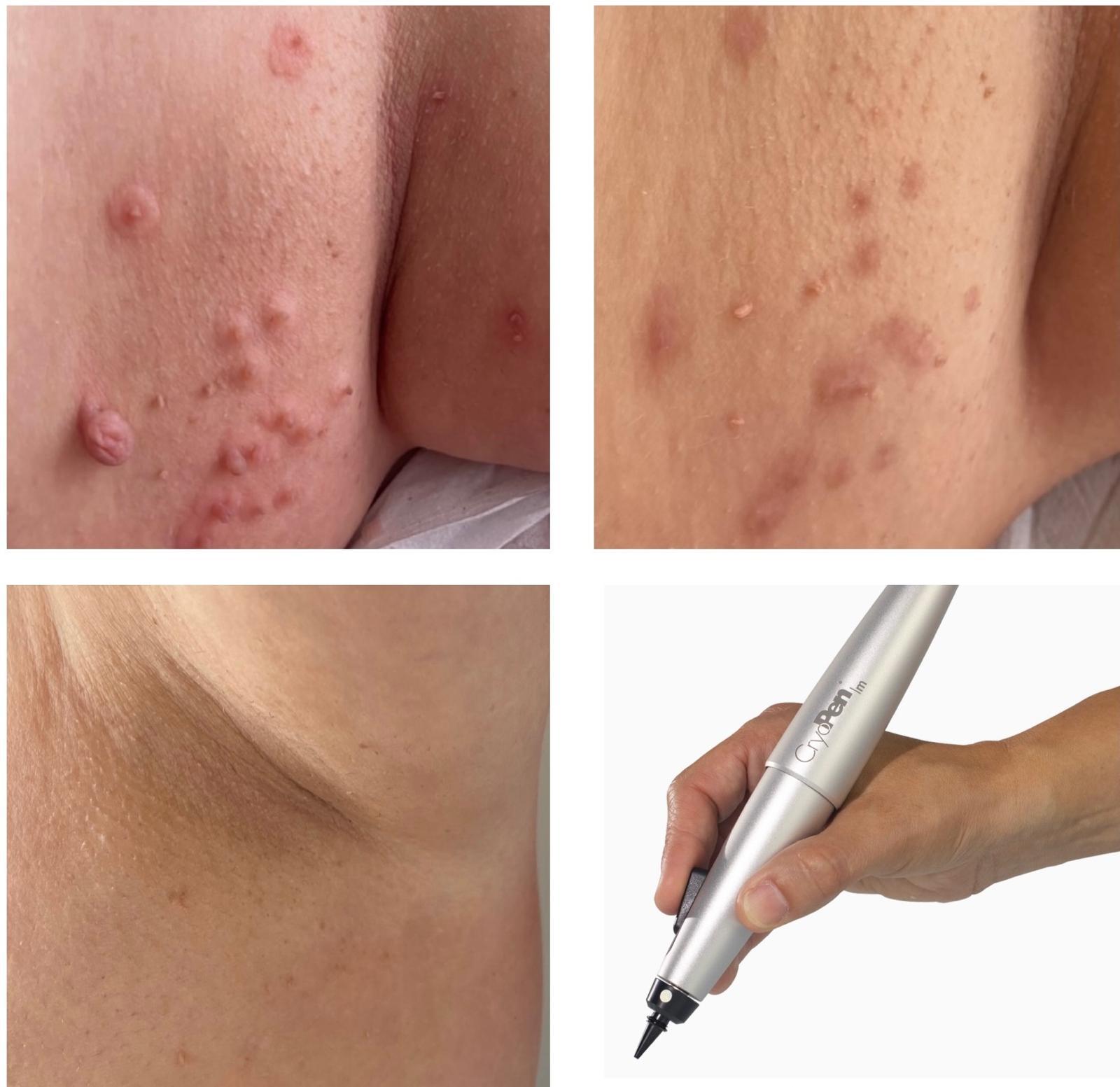 cryo-pen-halesowen